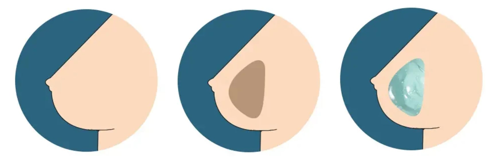 Hollow Breasts, Gel Breasts and Normal Breasts of Sex Doll Hollow Breasts Gel Breasts and Normal Breasts of Sex Doll